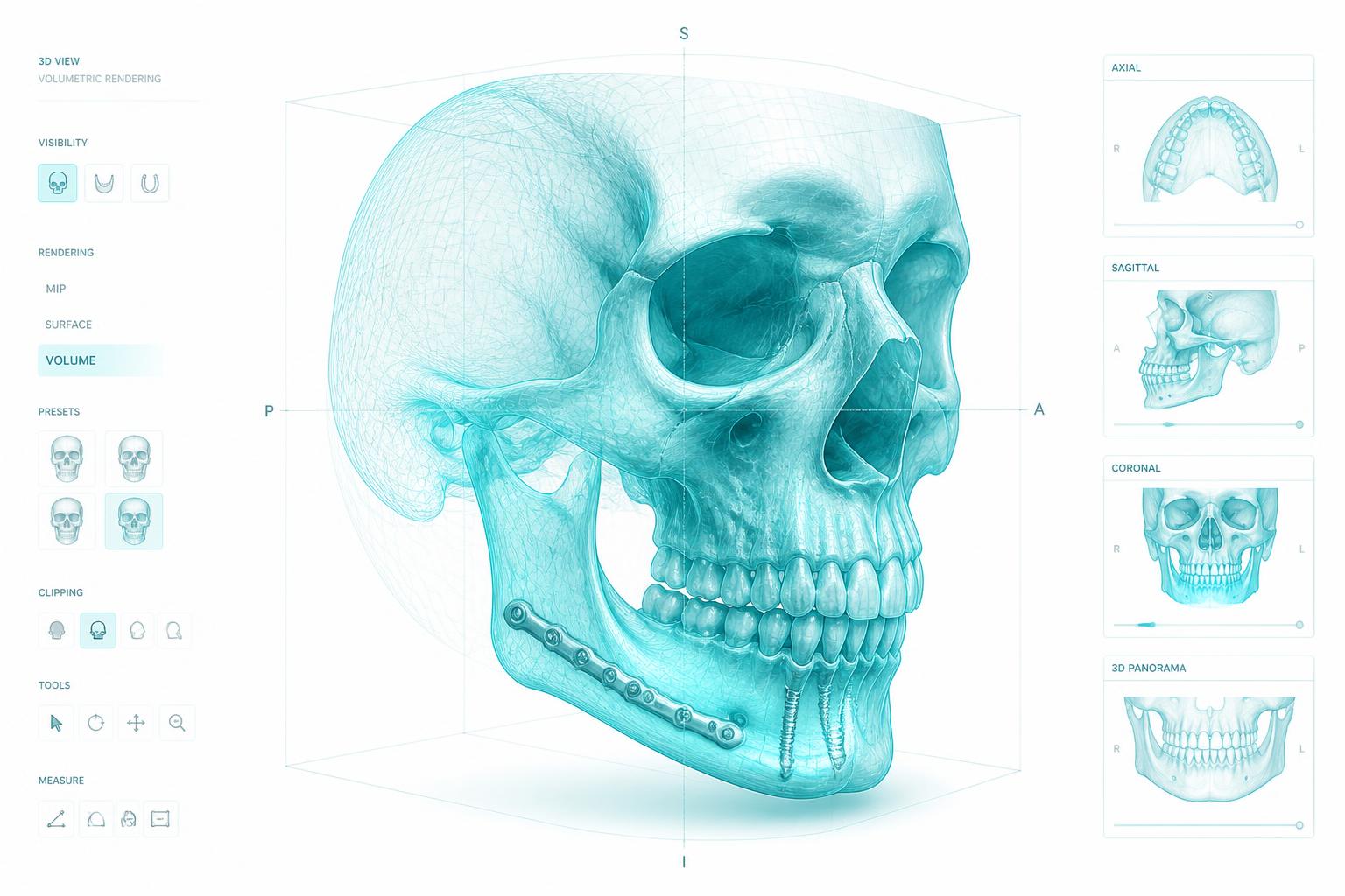 Planeación digital tridimensional en cirugía maxilofacial